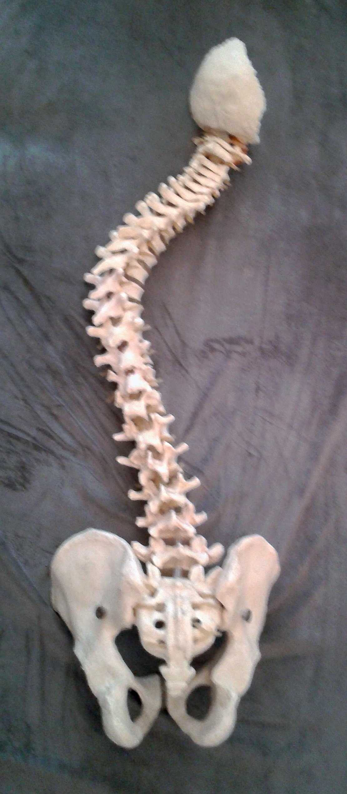 Spinal scoliosis